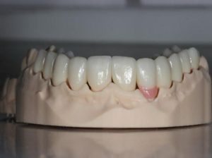 lower_teeth1