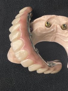 upper_teeth_unattached1